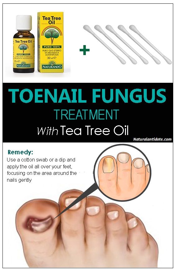 10 Amazing ways to use Tea tree oil for toenail fungus ...