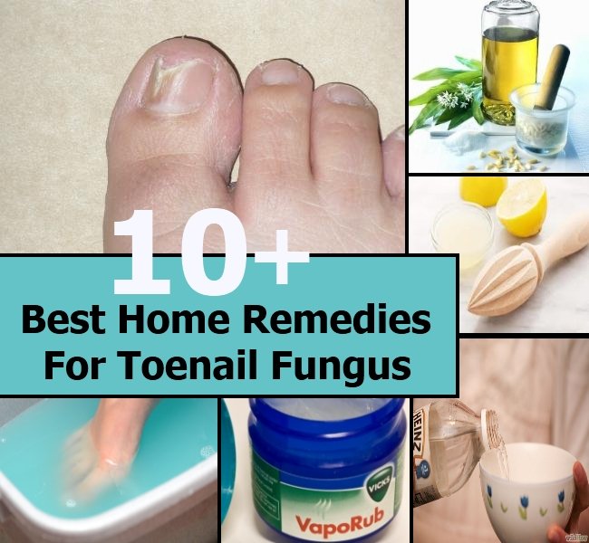 10+ Best Home Remedies For Toenail Fungus