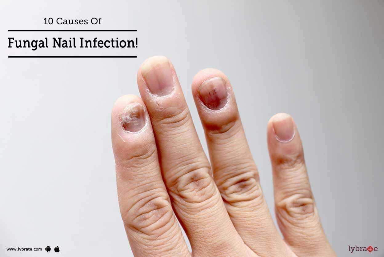 10 Causes Of Fungal Nail Infection!