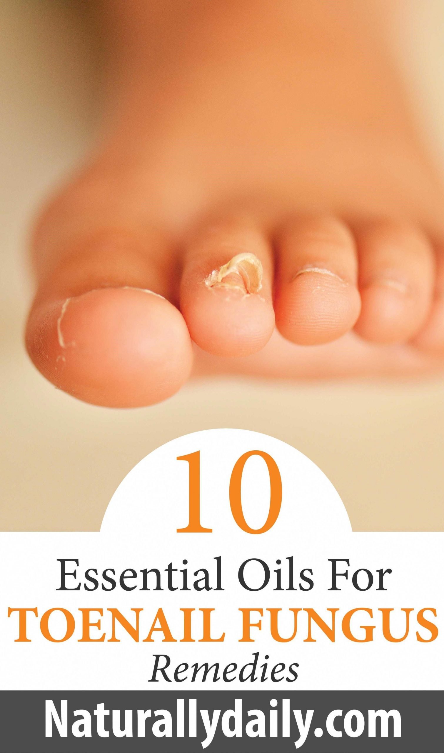 10 Essential Oils for Toenail fungus Remedies in 2020 ...