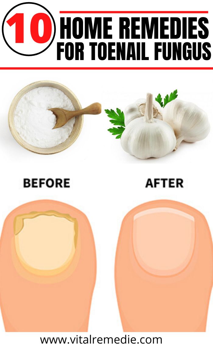 10 Home Remedies For Toenail Fungus in 2020