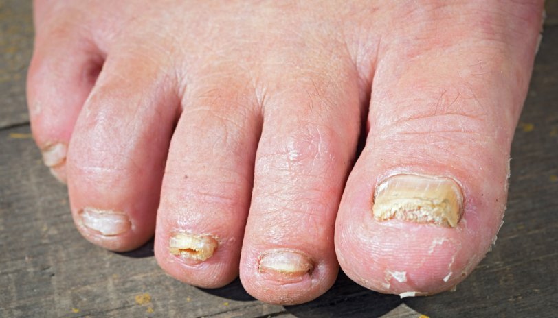 10 Tips for Foot Fungus Prevention and Treatment