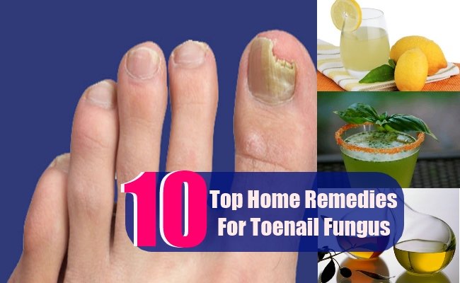 10 Top Home Remedies For Toenail Fungus