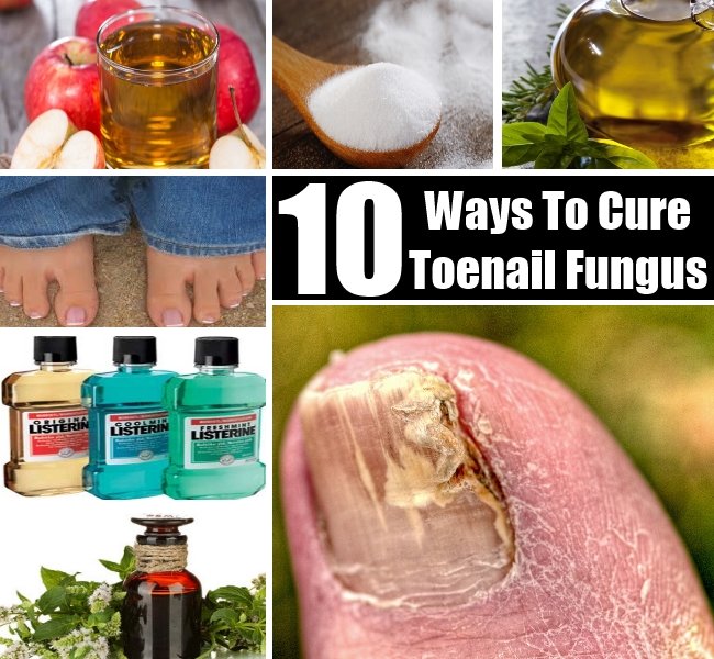 10 Ways To Cure Toenail Fungus Naturally
