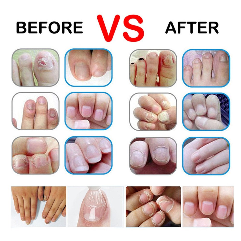 10ml Fungal Nail Fungus Treatment Feet Care Essence Toe Nail Fungus ...