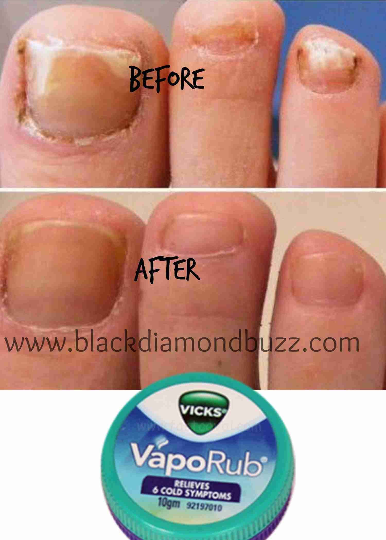 13 Myths Uncovered About Vicks Vaporub Uses (With images ...