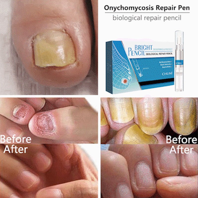 1Pc Fungal Nail Treatment Pen Effective Onychomycosis ...