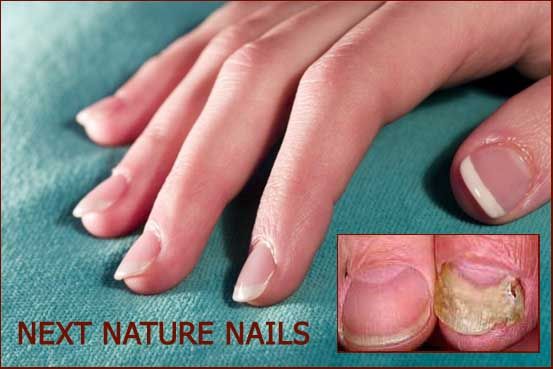 21 Awesome Acrylic over fungus nail for Trend 2021