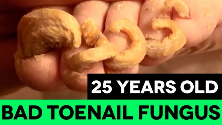 25 Years Old Severe Toenail Fungus Treatment (OVERNIGHT ...