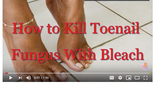 3 Effective Ways To Treat Toenail Fungus with Bleach in ...