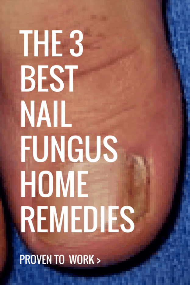 3 Home Remedies For Nail Fungus That Are Proven To Workâ¦