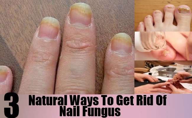 3 Natural Ways To Get Rid Of Nail Fungus â Natural Home ...