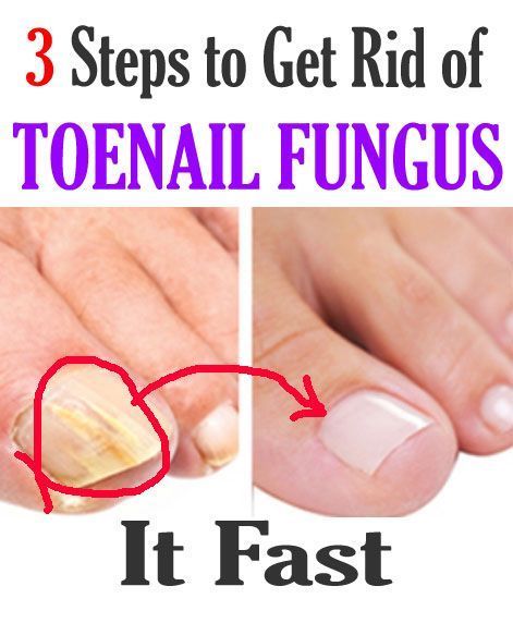 3 Steps To Get Rid Of ToeNail Fungus! #nailfungus #fungus ...