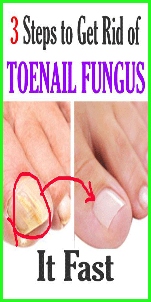 3 Steps To Get Rid Of Toenail Fungus!!