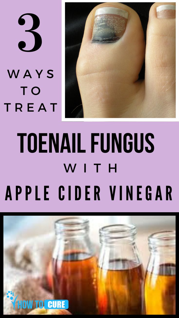 3 Ways To Treat Toenail Fungus With Apple Cider Vinegar ...