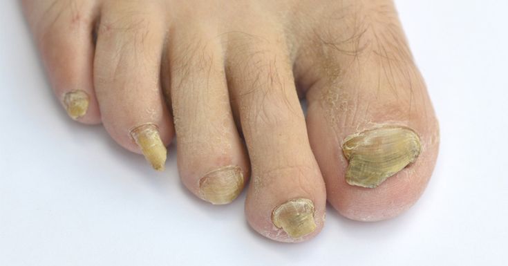 4 Natural Remedies That Cure Toenail Fungus FAST! AMAZING ...
