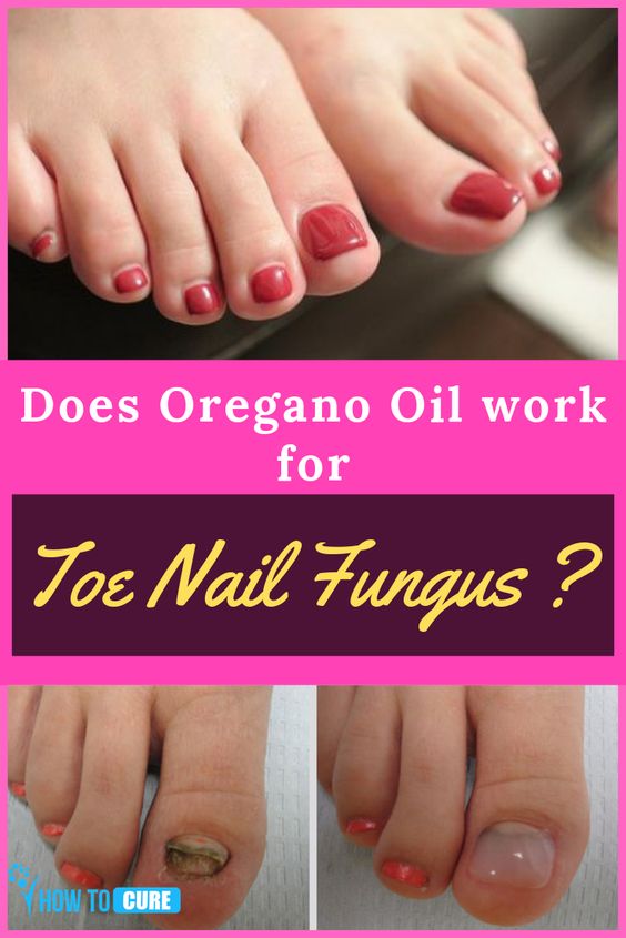 47 Best Of How Long To Treat Nail Fungus With Oregano Oil ...