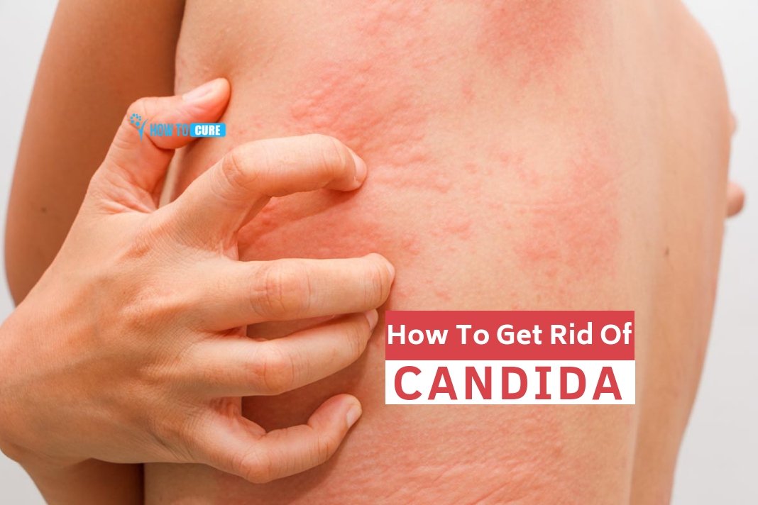 5 Amazing Natural Ways For How To Get Rid Of Candida