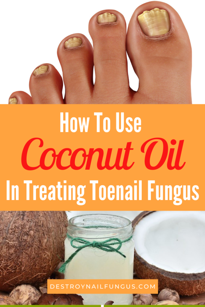 5 Amazing Ways To Use Coconut Oil For Toenail Fungus