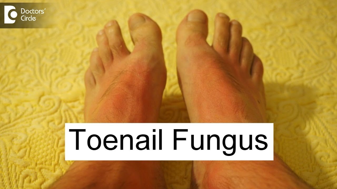 5 Ayurvedic proven ways to manage toenail fungus