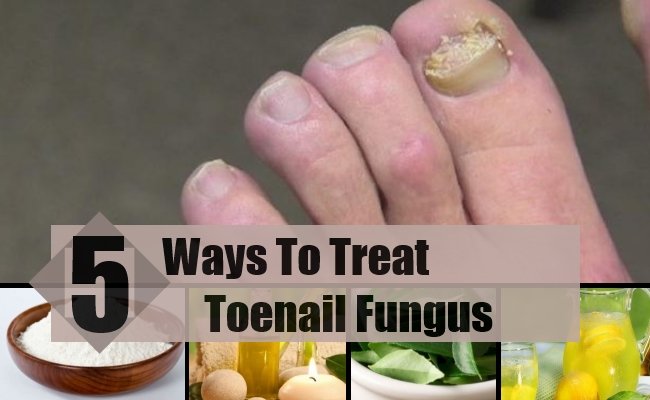 5 Best And Effective Ways For Toenail Fungus Treatments