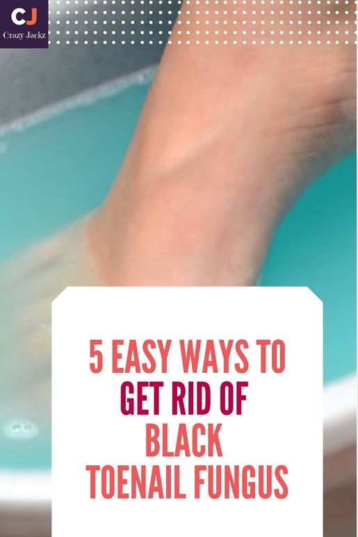 5 Easy ways to Get rid of Black toenail fungus