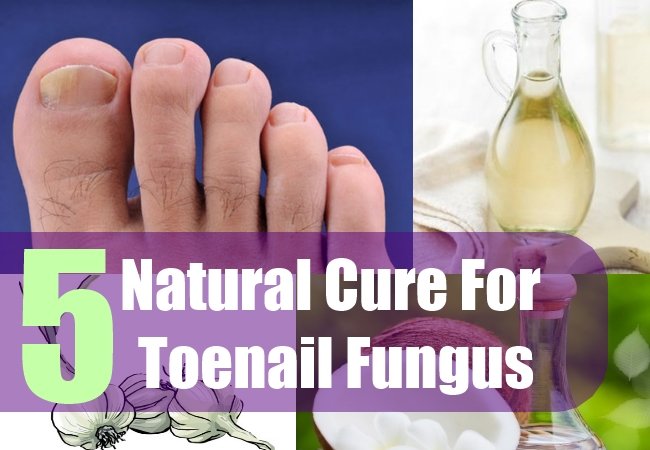 5 Natural Cure For Toenail Fungus