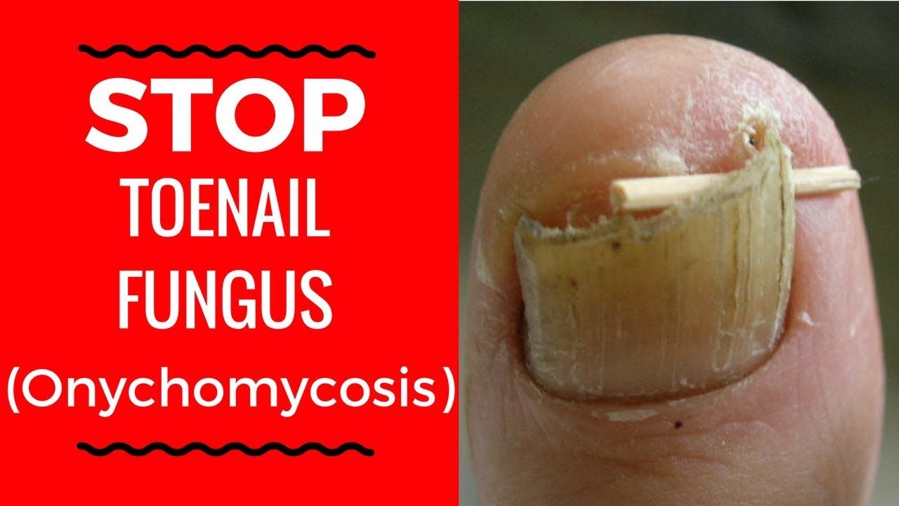 5 Natural Nail Fungus Treatments to Stop Onychomycosis ...
