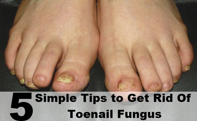5 Simple Tips to Get Rid Of Toenail Fungus