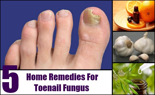 5 Tips On Home Remedy Toenail Fungus