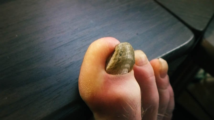 5 year old dead toe nail. Still hanging in there.