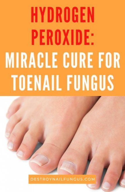 58 Ideas For Yellow Toe Nails Remedy Fungal Infection in ...