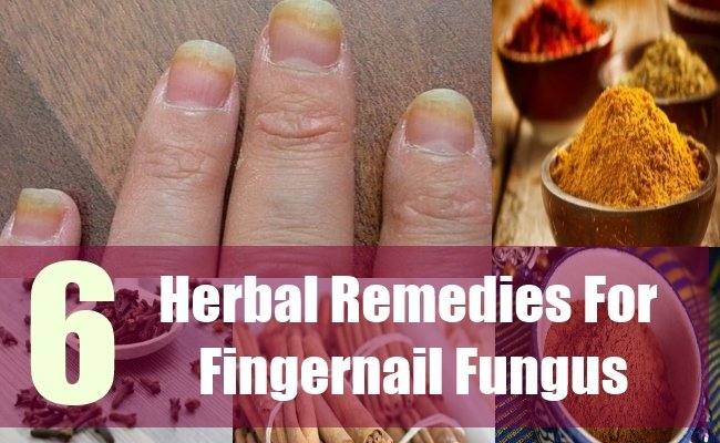 6 Excellent Herbal Remedies For Fingernail Fungus  Natural Home ...
