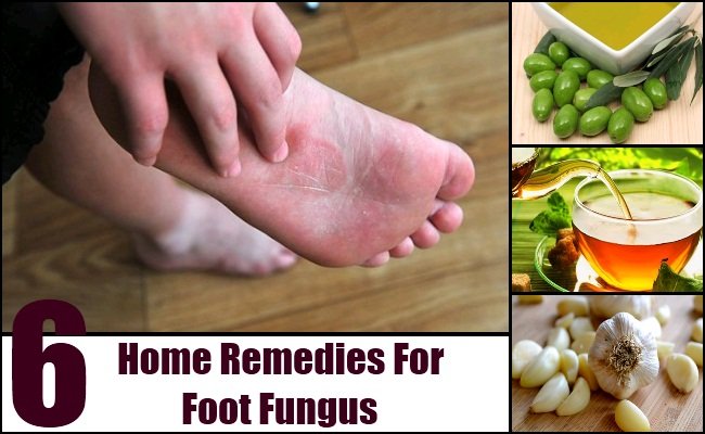 6 Home Remedies For Foot Fungus