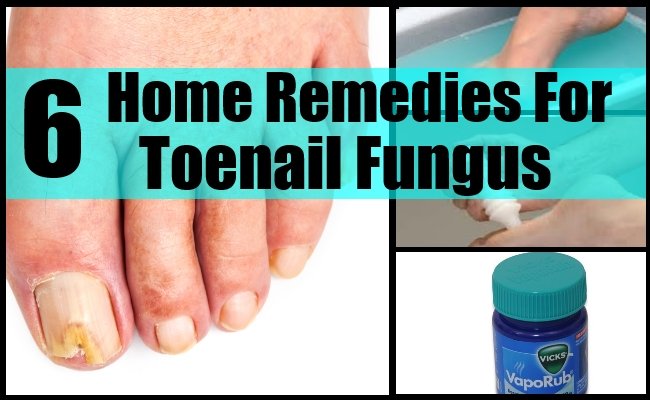 6 Home Remedies For Toenail Fungus
