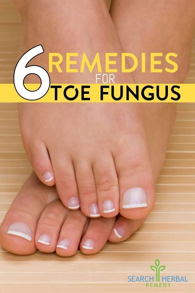 6 Remedies For Toe Fungus #FootSoakForDryFeet #FootSoakDiy