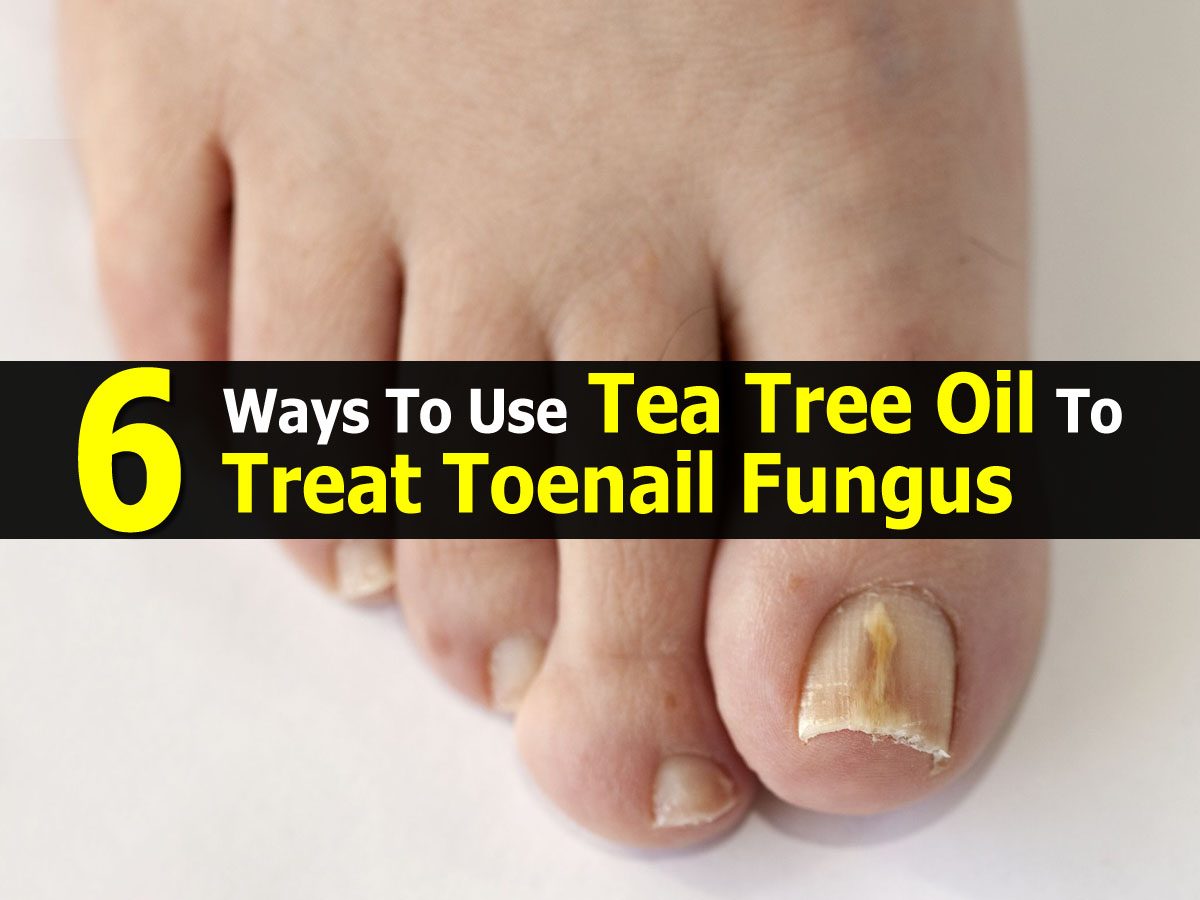 6 Ways To Use Tea Tree Oil To Treat Toenail Fungus