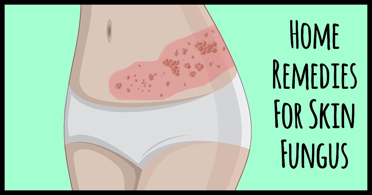 7 Easy And Effective Home Remedies For Skin Fungus