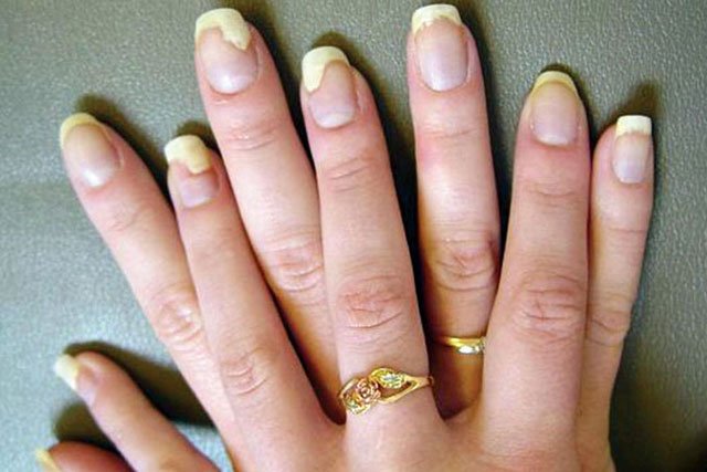 7 Symptoms To Spot The Nail Fungus Before it Harms