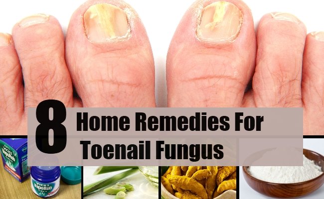 8 Home Remedies For Toenail Fungus