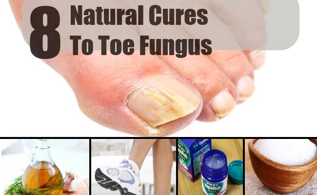 8 Natural Cures For Toe Fungus