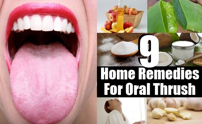 9 Beneficial Home Remedies For Oral Thrush