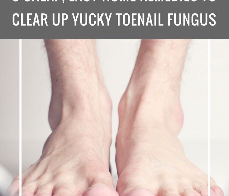 9 Cheap Easy Home Remedies to Clear Up Yucky Toenail Fungus