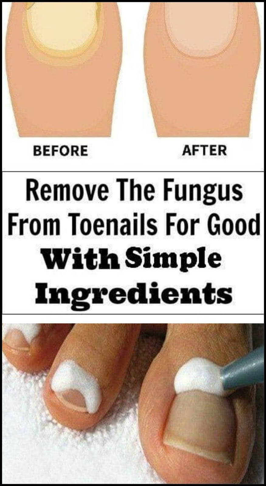 9 Simple Ingredients to Remove The Fungus From Toenails