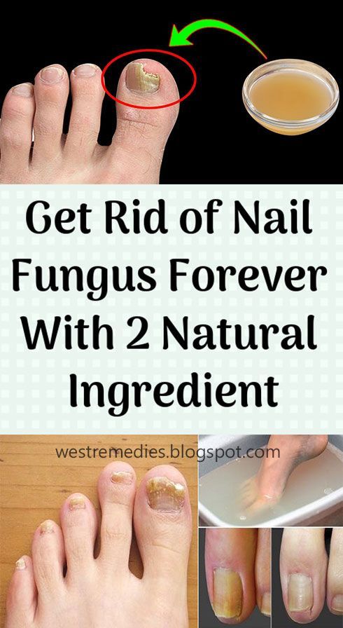 A fungal nail occurs when a fungus attacks a toenail, a ...