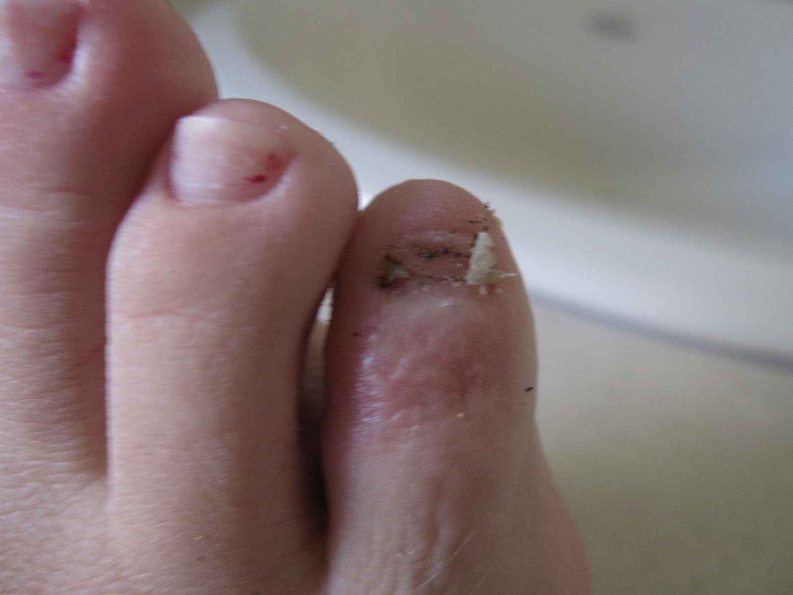 A Lady Reveals Nothing: RIP, Pinky Toenail