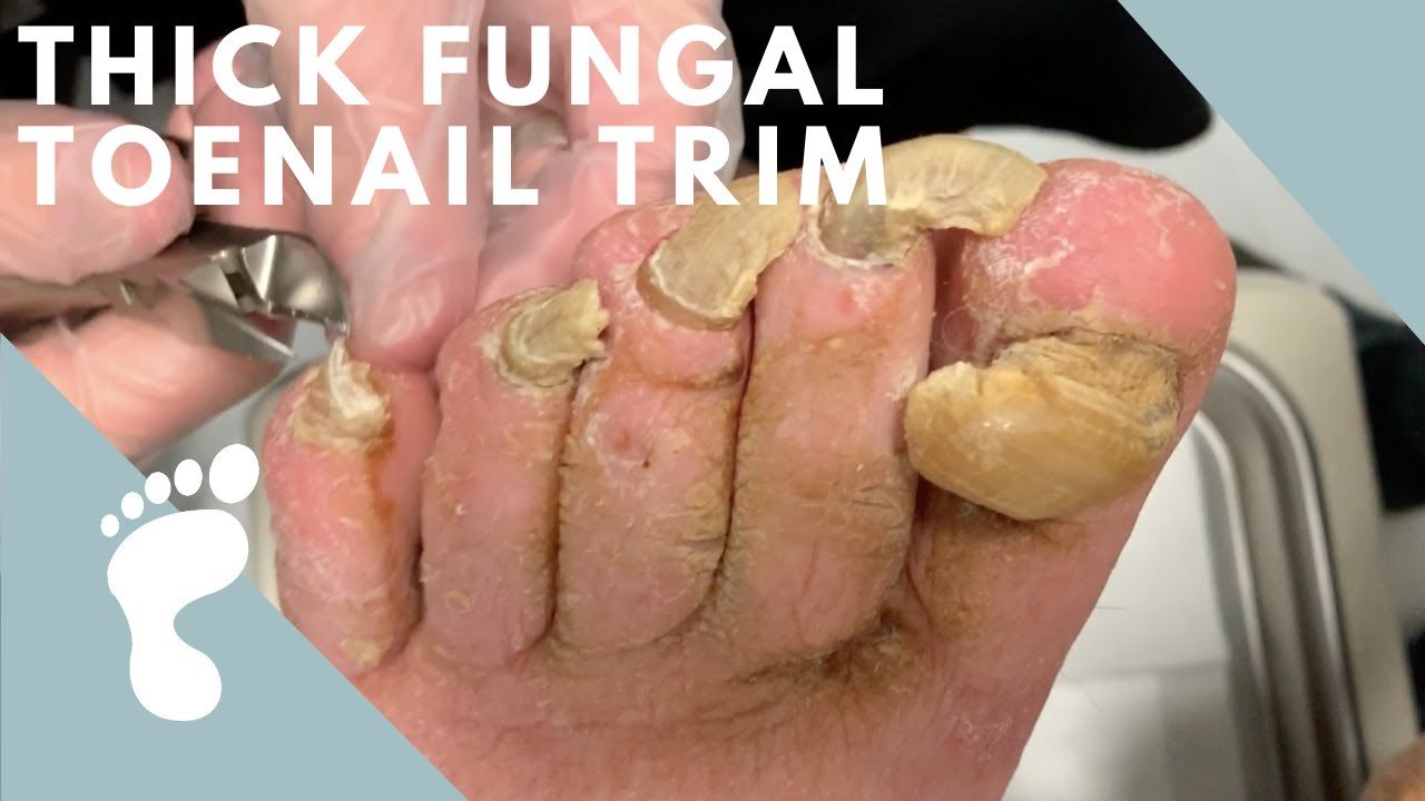 A Thick and Fungal Toenail!
