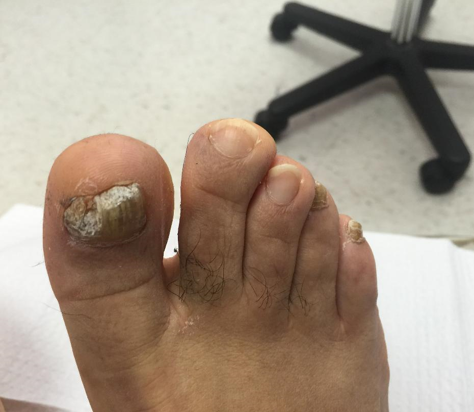 About Toenail Fungus. Before and After Images