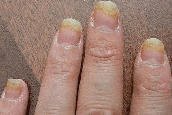 Acrylic Nail Fungus ~ How to Prevent Fungus