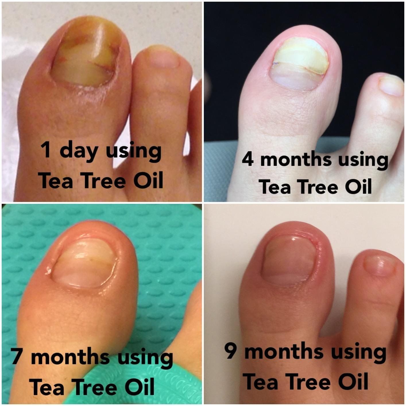 Amazon.com: Tea Tree Oil Foot Soak With Epsom Salt, Helps Treat Nail ...
